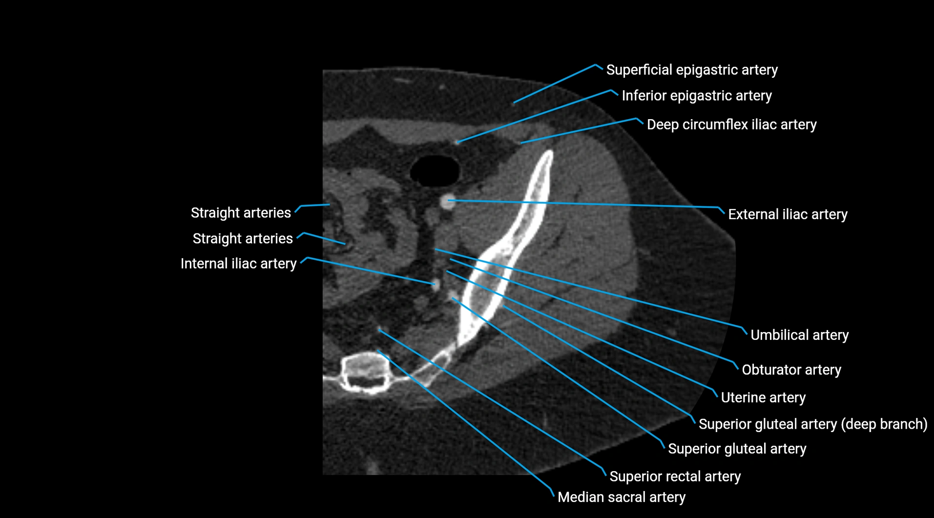 CTA lower limb cross sectional anatomy labelled image _34.webp